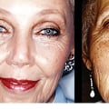 What is the best procedure for aging face?