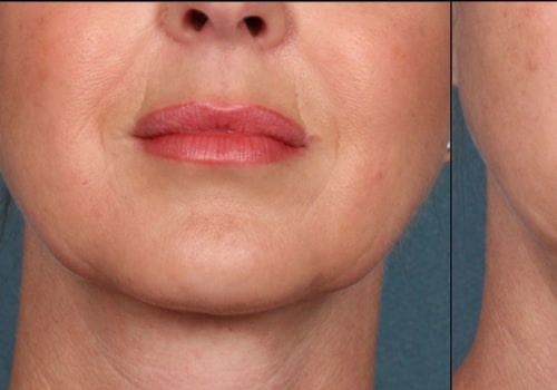 What is the best procedure for aging face?