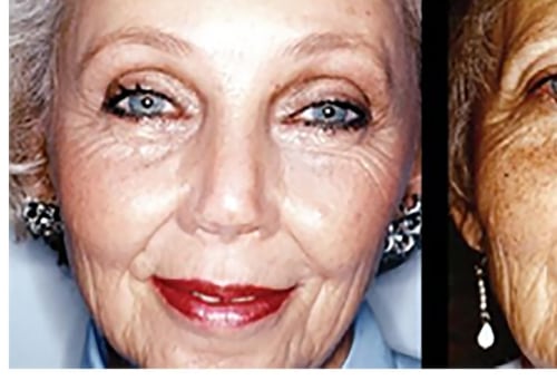 What is the best procedure for aging face?