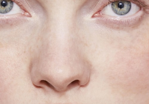 What is the best non invasive treatment for wrinkles?